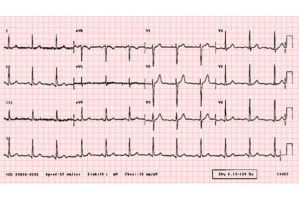 ECG