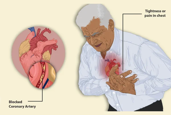 Angina