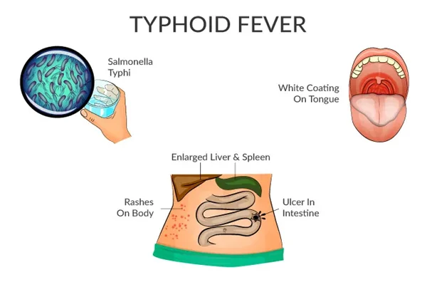 Typhoid