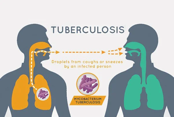 Tuberculosis